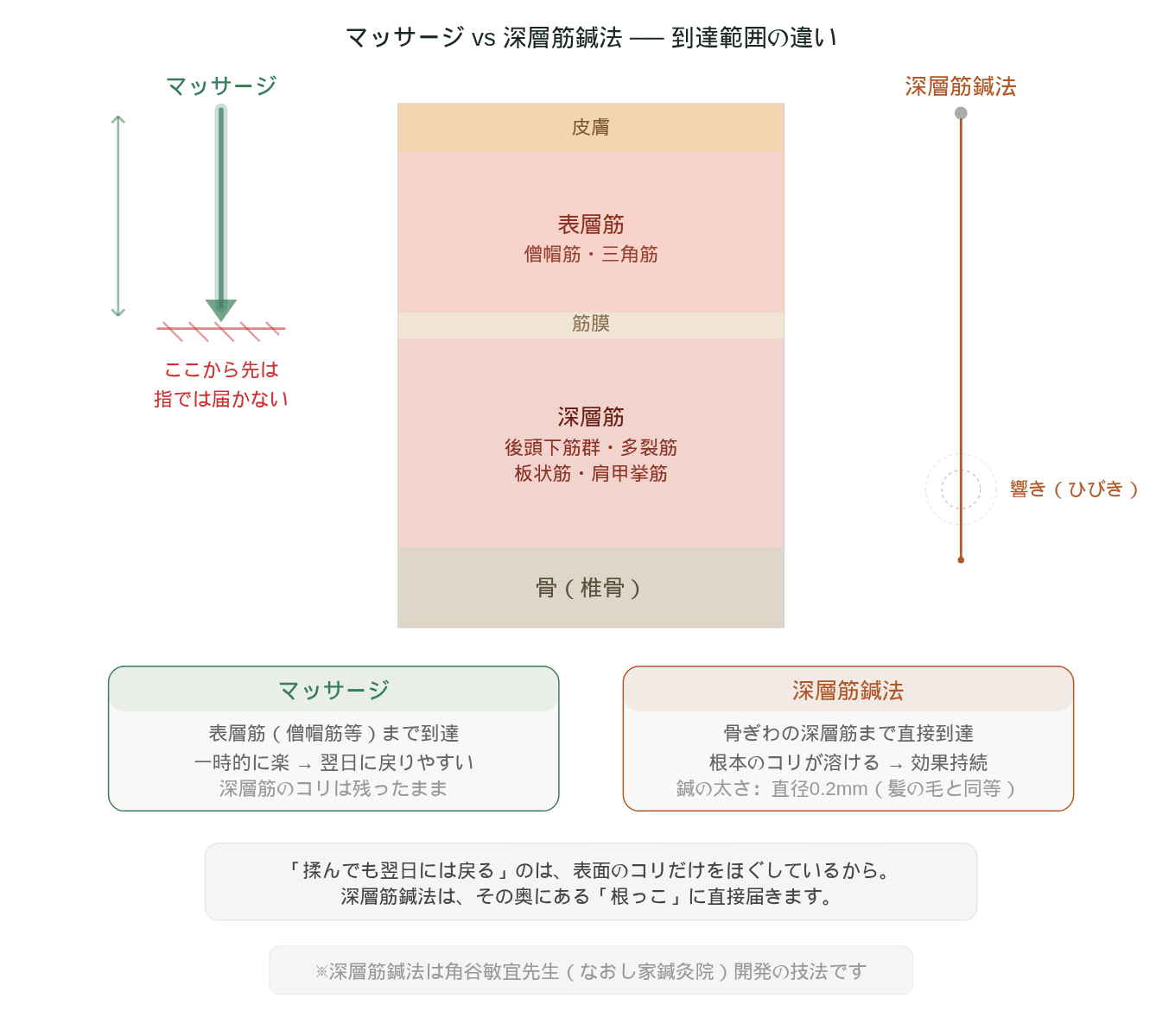 慢性肩こりに対するマッサージと深層筋鍼法の到達範囲の違い ── 表層筋にとどまるマッサージと骨ぎわまで届く鍼の比較イラスト