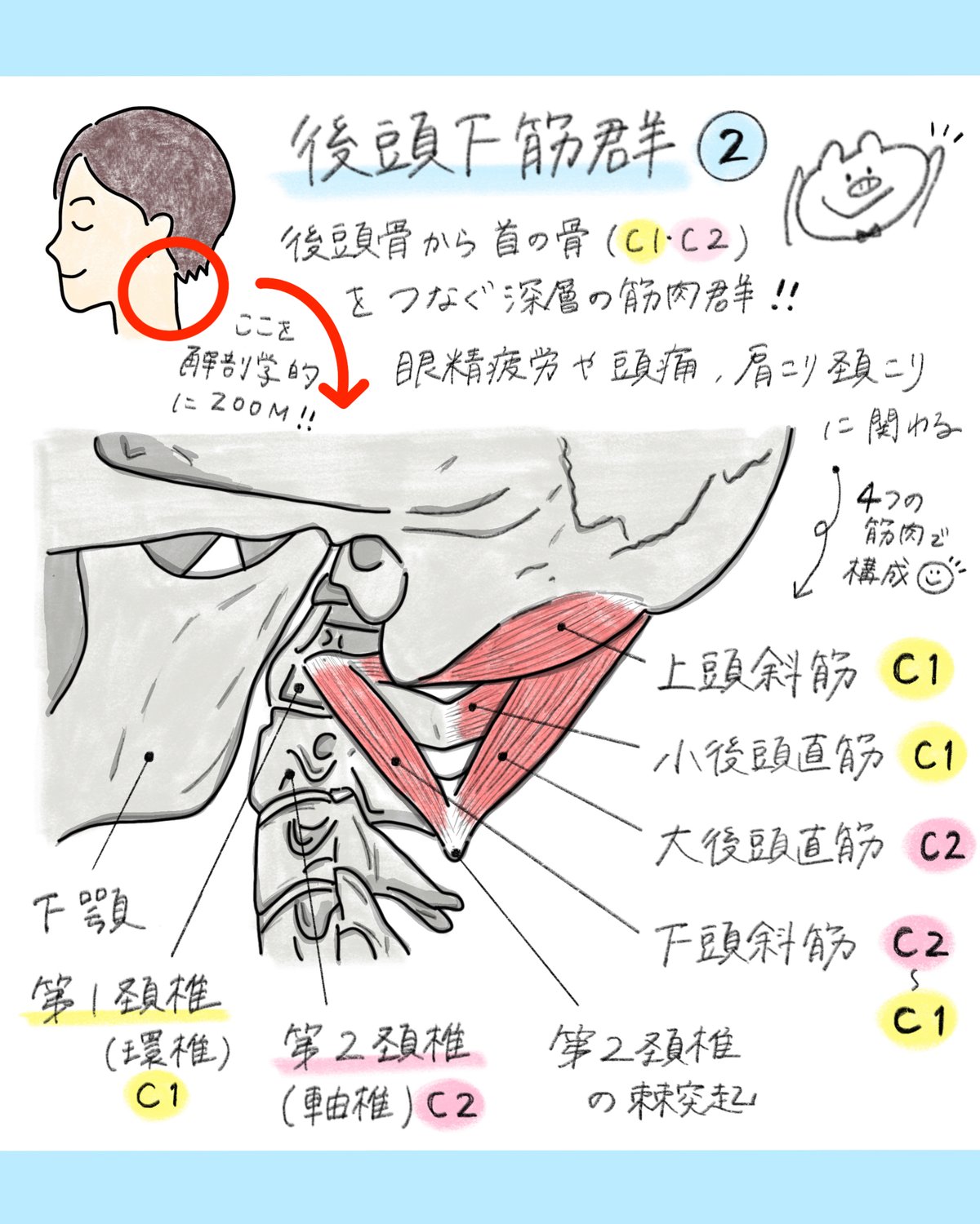 横から見た後頭下筋群のイラスト。左上の横顔の赤丸（耳の後ろ下、首のつけ根）を拡大し、後頭骨と第1頸椎・第2頸椎をつなぐ4つの筋肉（上頭斜筋・小後頭直筋・大後頭直筋・下頭斜筋）を赤で示している